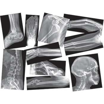 Roylco X-Rays, Broken Bones